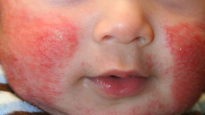 acute facial eczema condition in baby