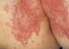 5 Common Skin Conditions/Rashes in Babies/Children