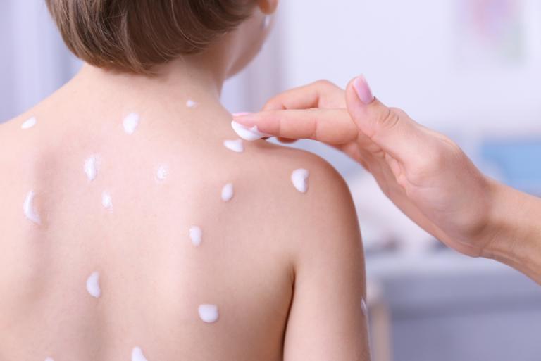 chickenpox-in-children-prevention-kids-clinic-singapore