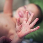 Child With Hand Foot Mouth Disease (HFMD)