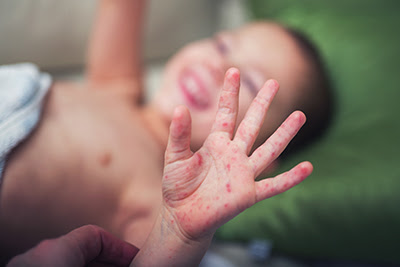 Child With Hand Foot Mouth Disease (HFMD)