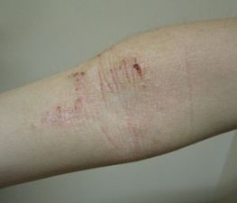 5 Common Skin Conditions/Rashes in Babies/Children | Kids Clinic