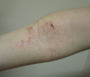 chronic atopic eczema in flexural of an older child