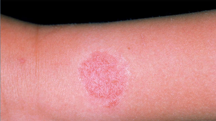 A skin rash or irritation caused by direct contact with nickel