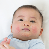 Babies With Eczema