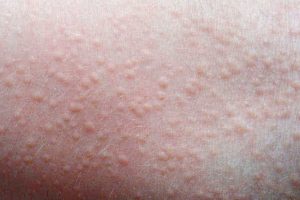 Hives on toddler skin