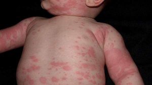 Hives in children and babies