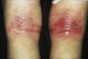 Acute atopic eczema behind the knees of a toddler