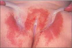 Diaper rash skin condition in babies and children