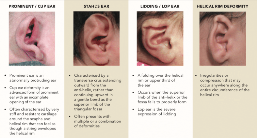 Ear Molding NonSurgical Ear Correction Kids Clinic Singapore