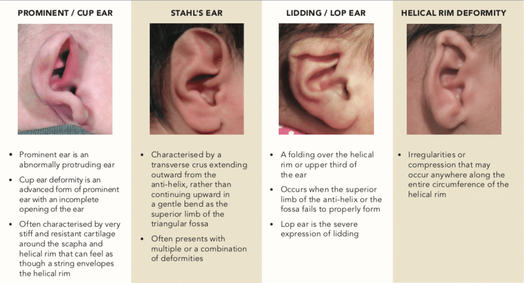 Ear Molding In Kids