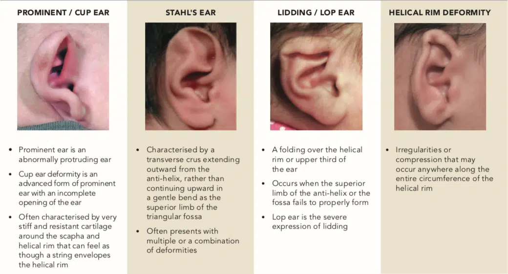 Protruding Ears - Prominent Ears - Earwell™ Infant Ear Correction System