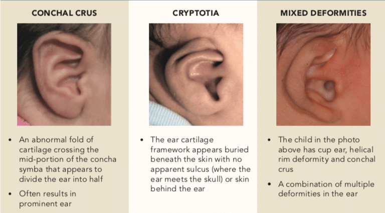 Types Of Ear Molding In Kids