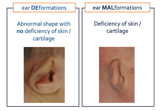 Ear Deformations And Ear Malformations