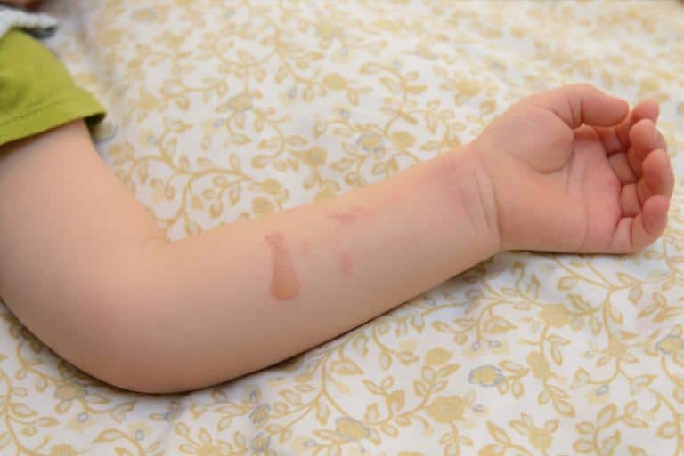 Common skin condition in children such as eczema, diaper rash, and skin infections