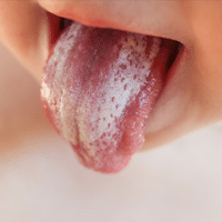 Oral Thrush Also Known As Candidiasis Fungal Infection