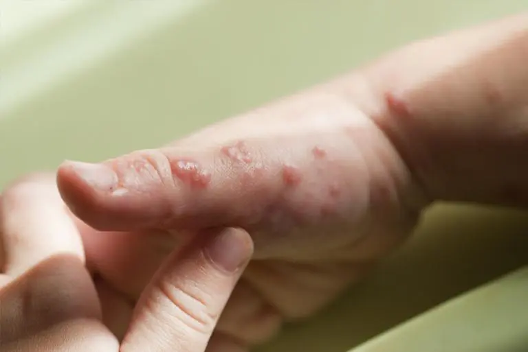 viral skin infections