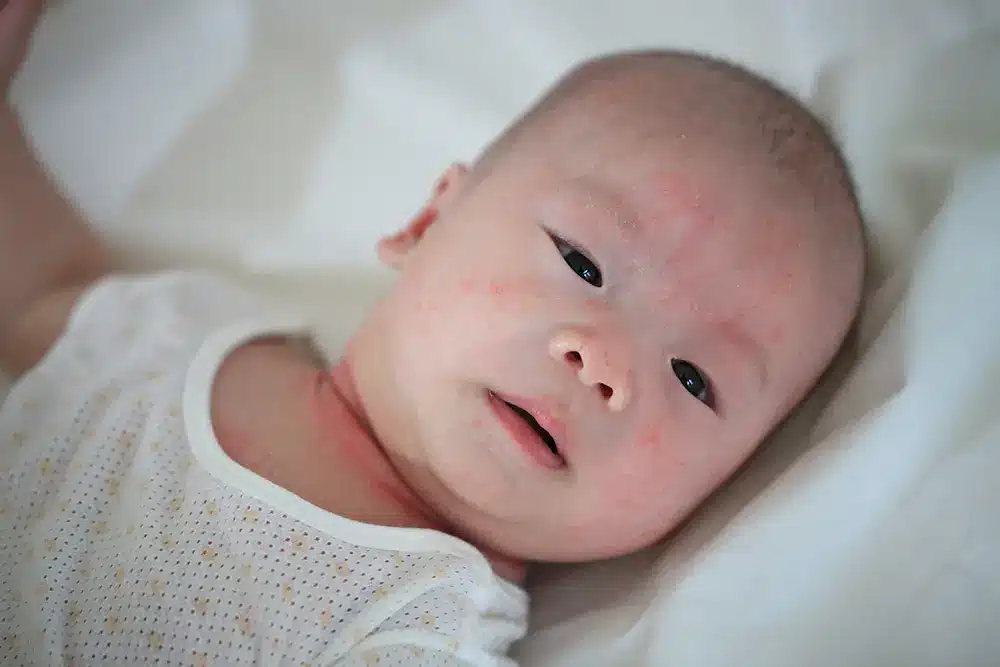 Why Does My Baby Have Pimples